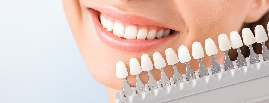 Белоснежная улыбка после чистки
