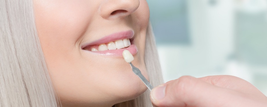 Виниры на зубы