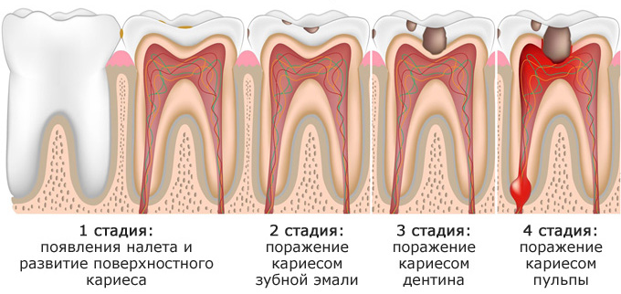 Этапы развития кариеса