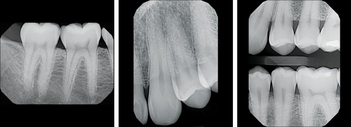 Рентгеновские снимки зубов