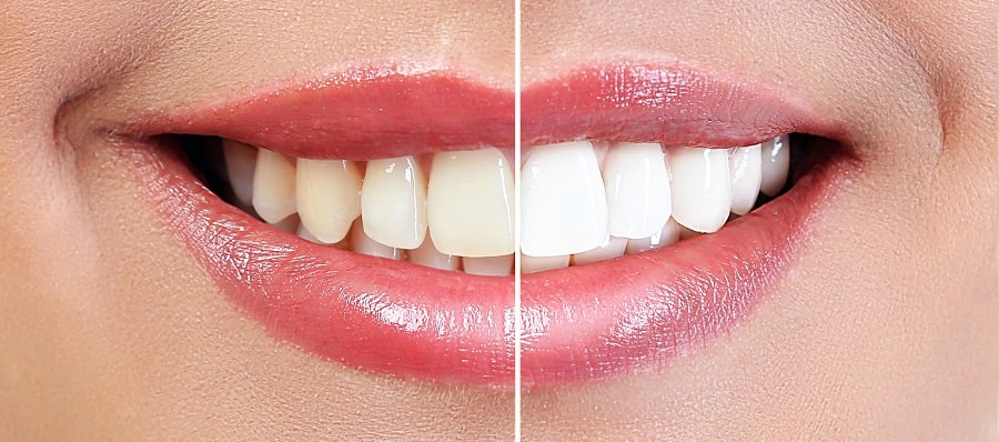 Отбеливание до и после